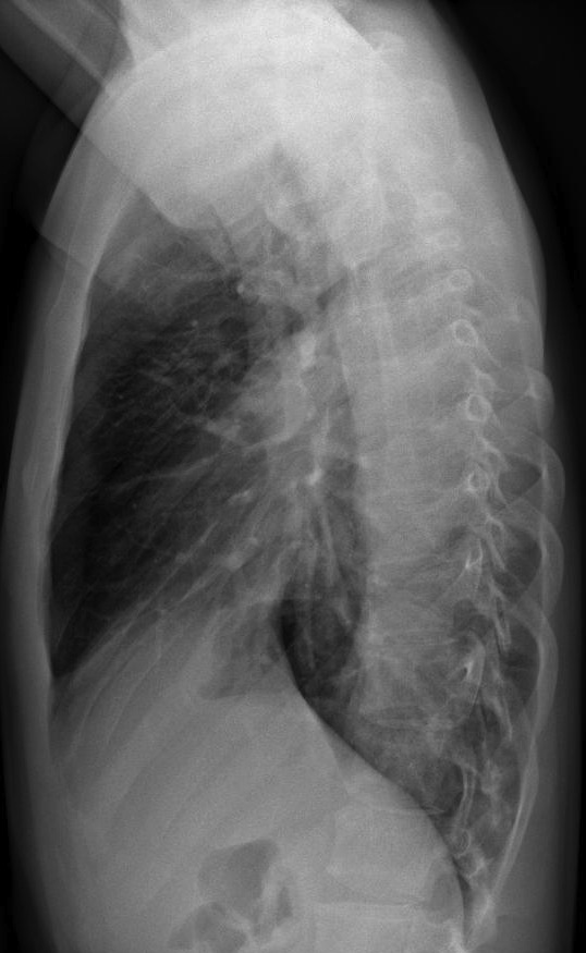 17-year-old male, lateral chest