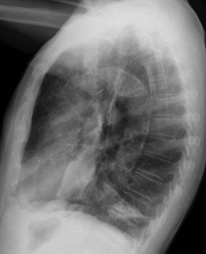 55-year-old male, lateral chest