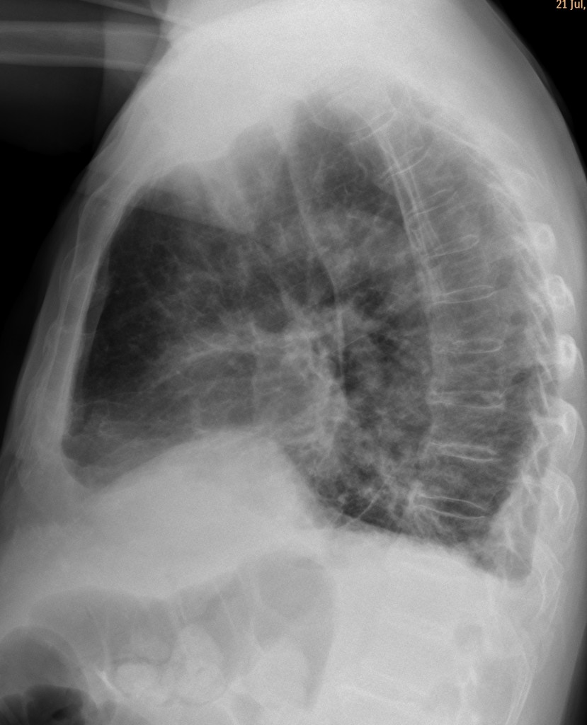 80-year-old male, lateral chest