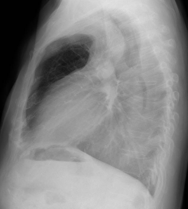 47-year-old man, lateral chest