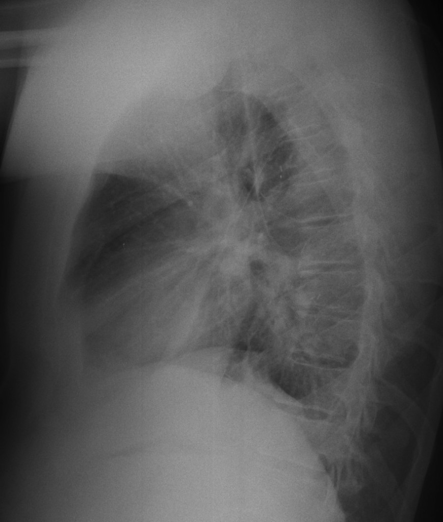 34-year-old male, lateral chest
