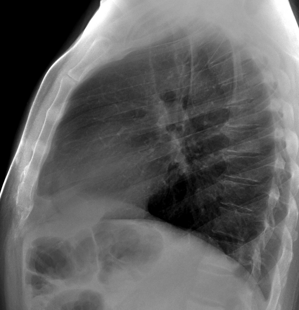 52-year-old male, lateral chest