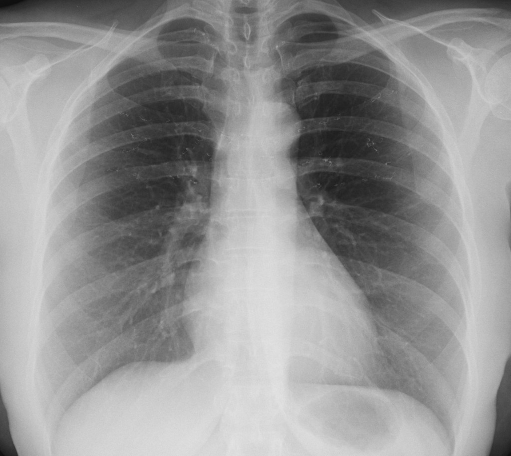 46-year-old woman, PA chest