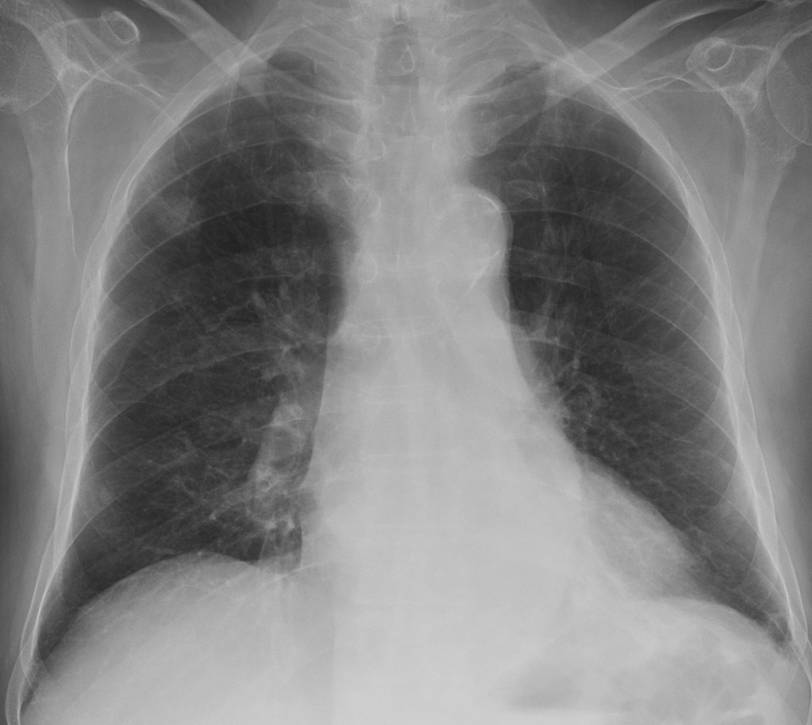 52-year-old man with a solitary pulmonary nodule