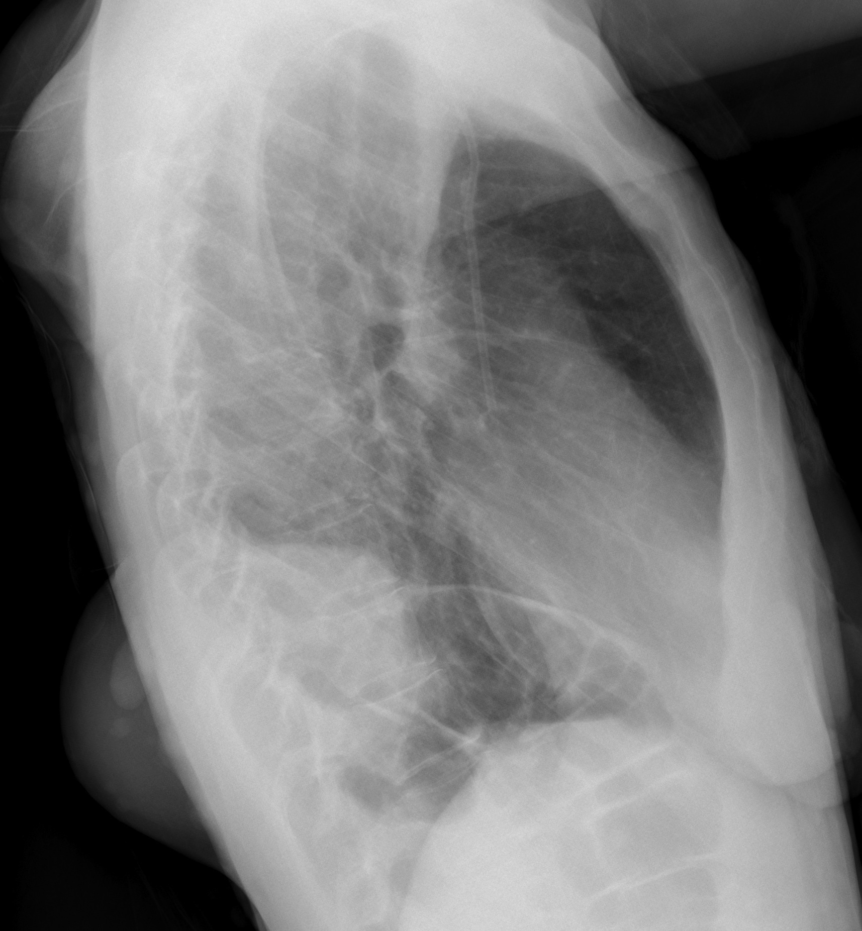 46-year-old woman, lateral chest