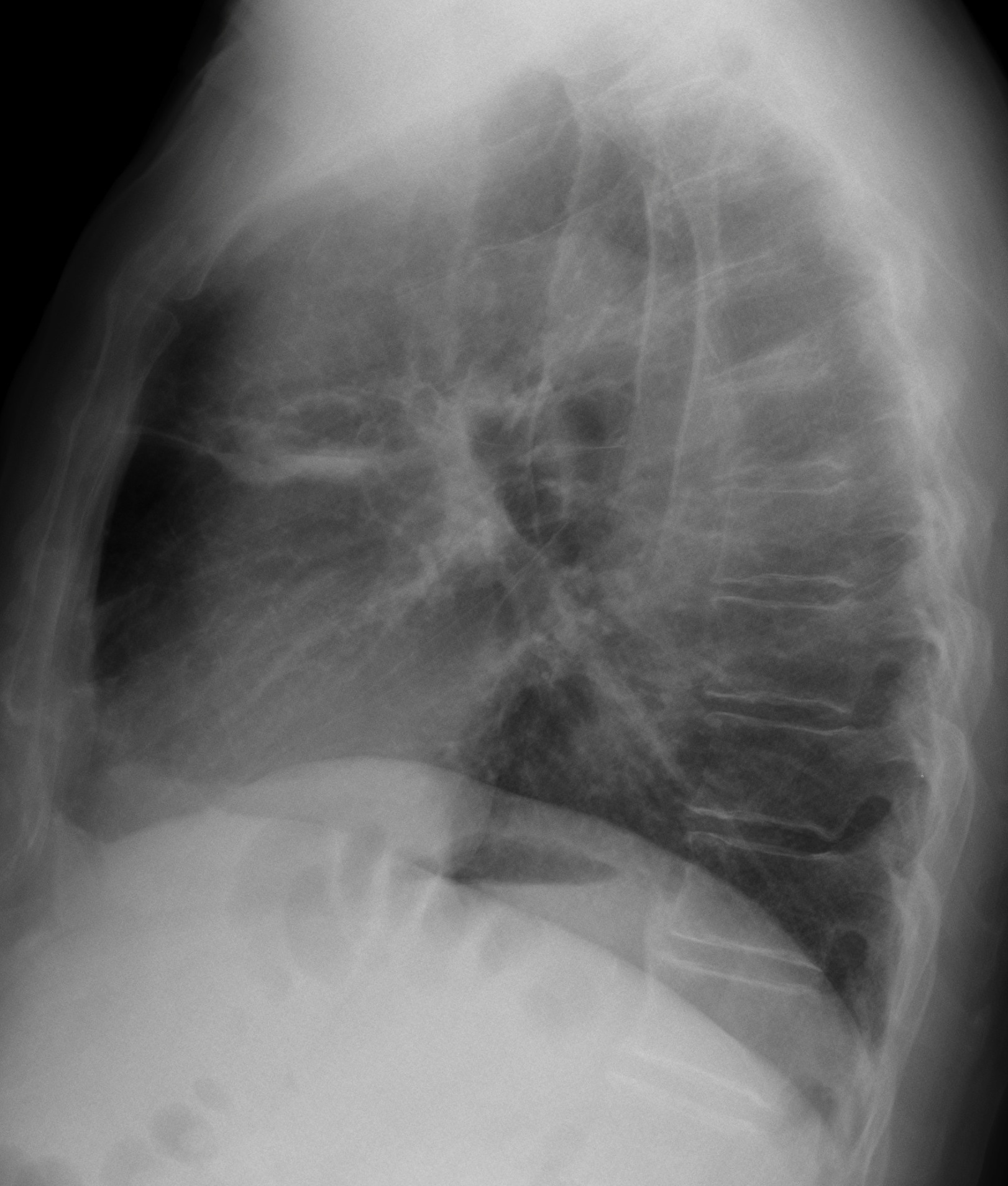 78-year-old male, lateral chest