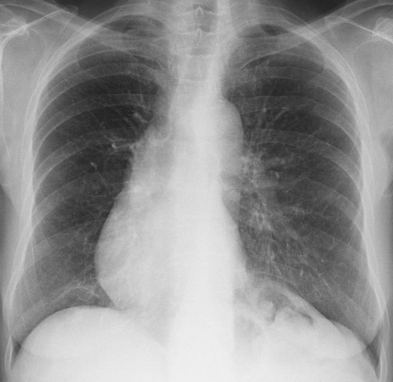 73-year-old woman, PA chest