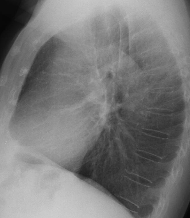 73-year-old woman, lateral chest