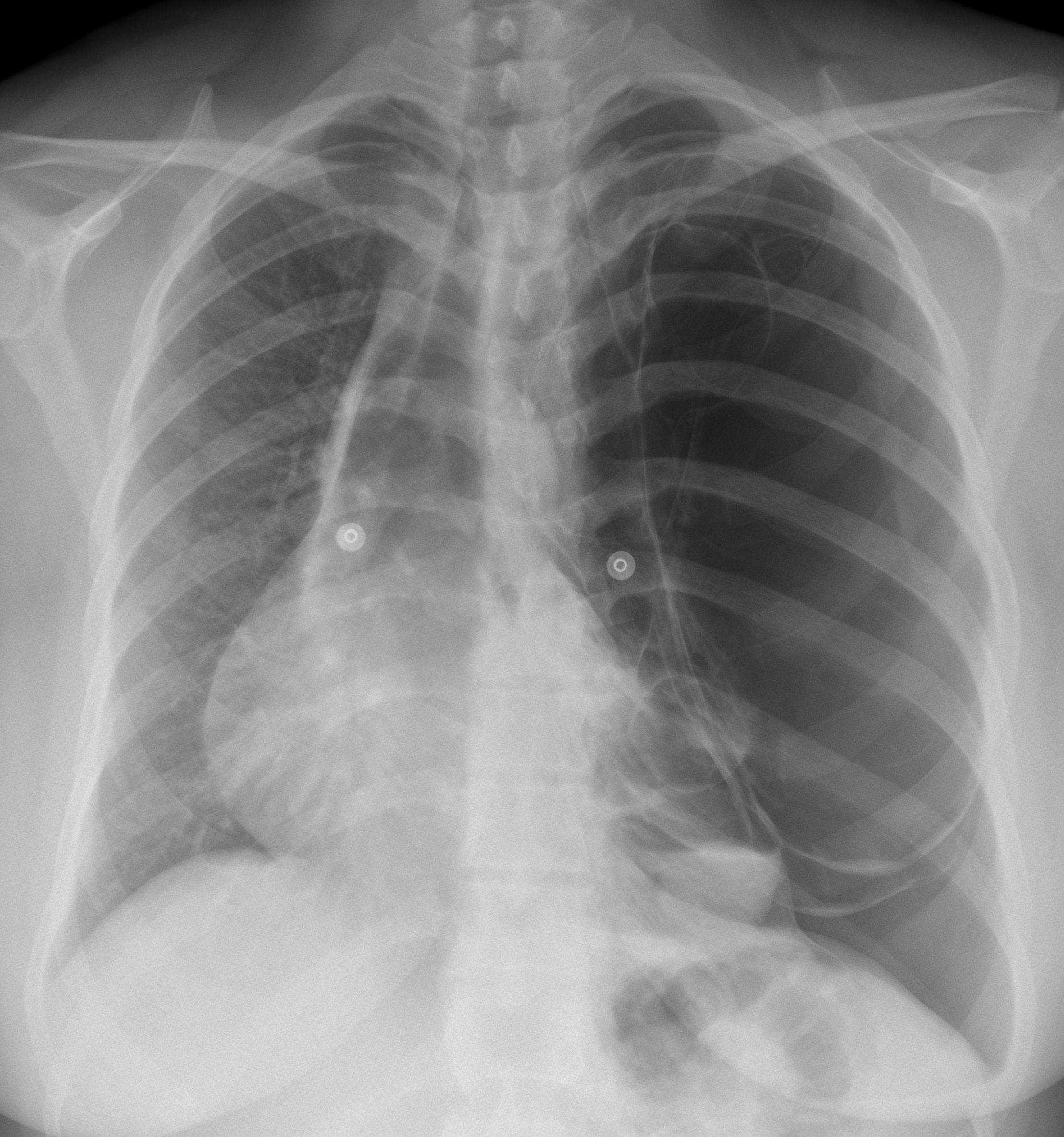 39-year-old woman, PA chest