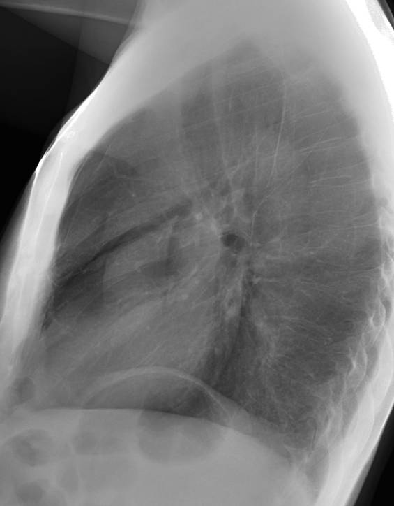 52-year-old man, lateral chest