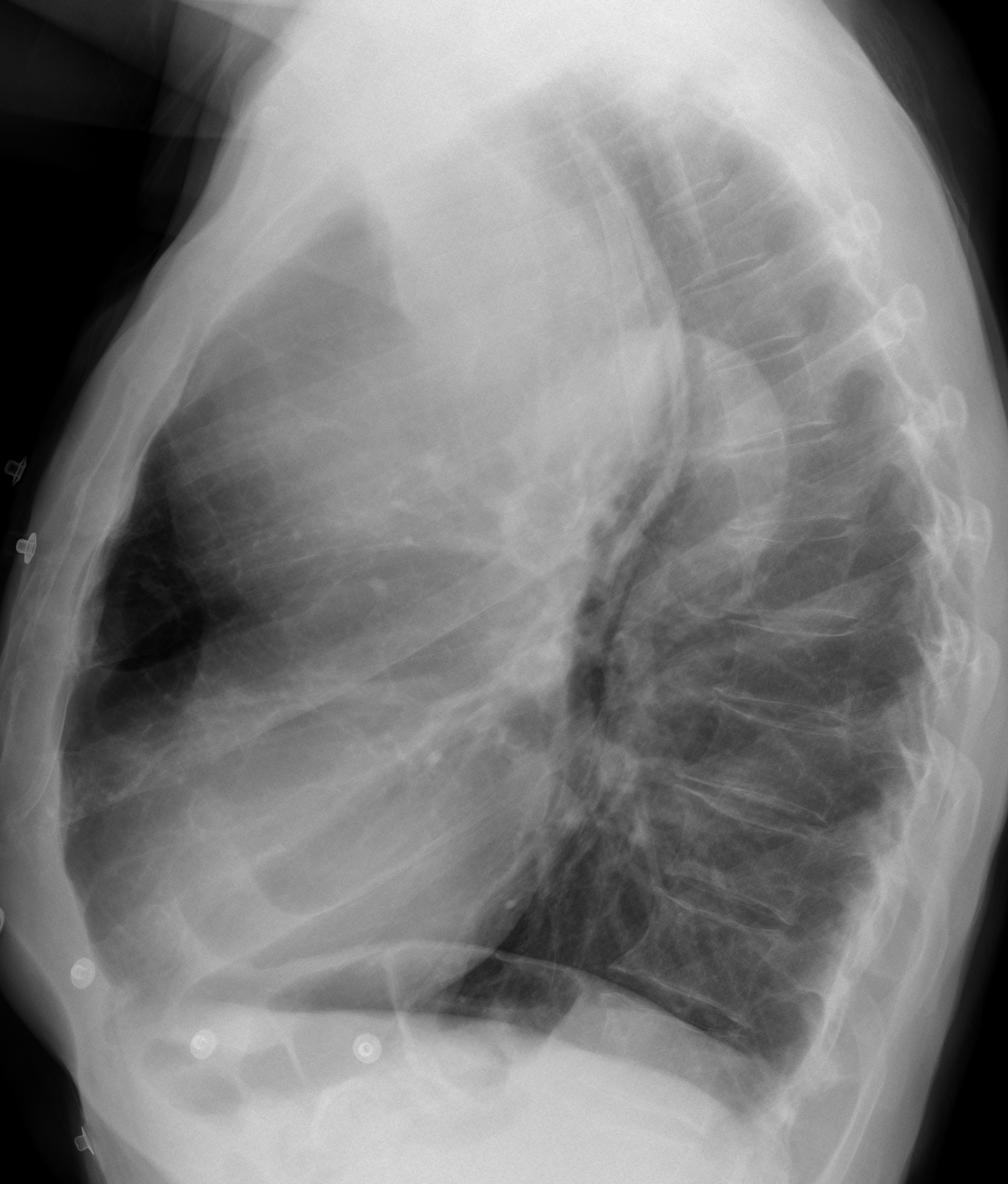 69-year-old man with chest pain, lateral chest