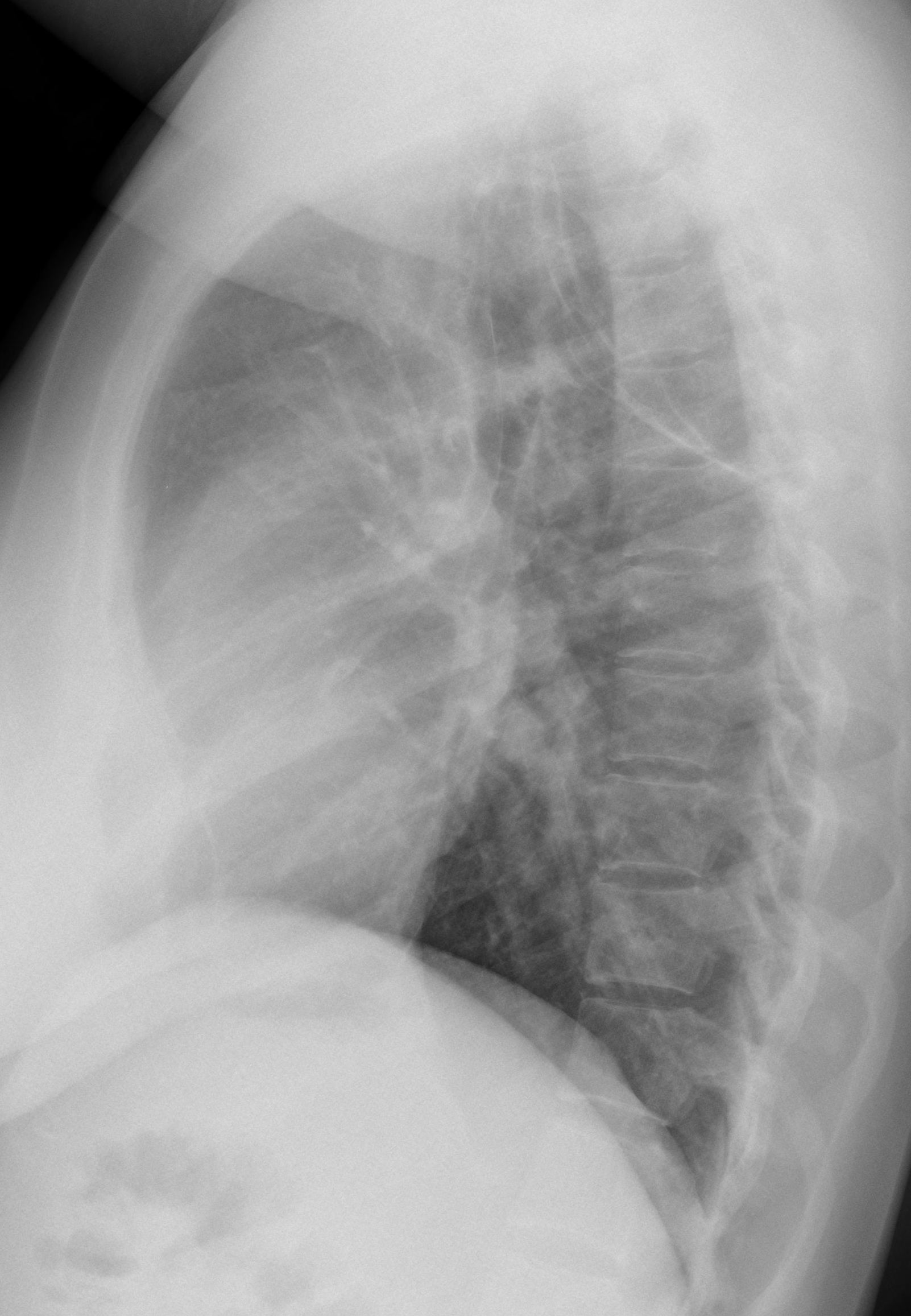 39-year-old woman, lateral chest