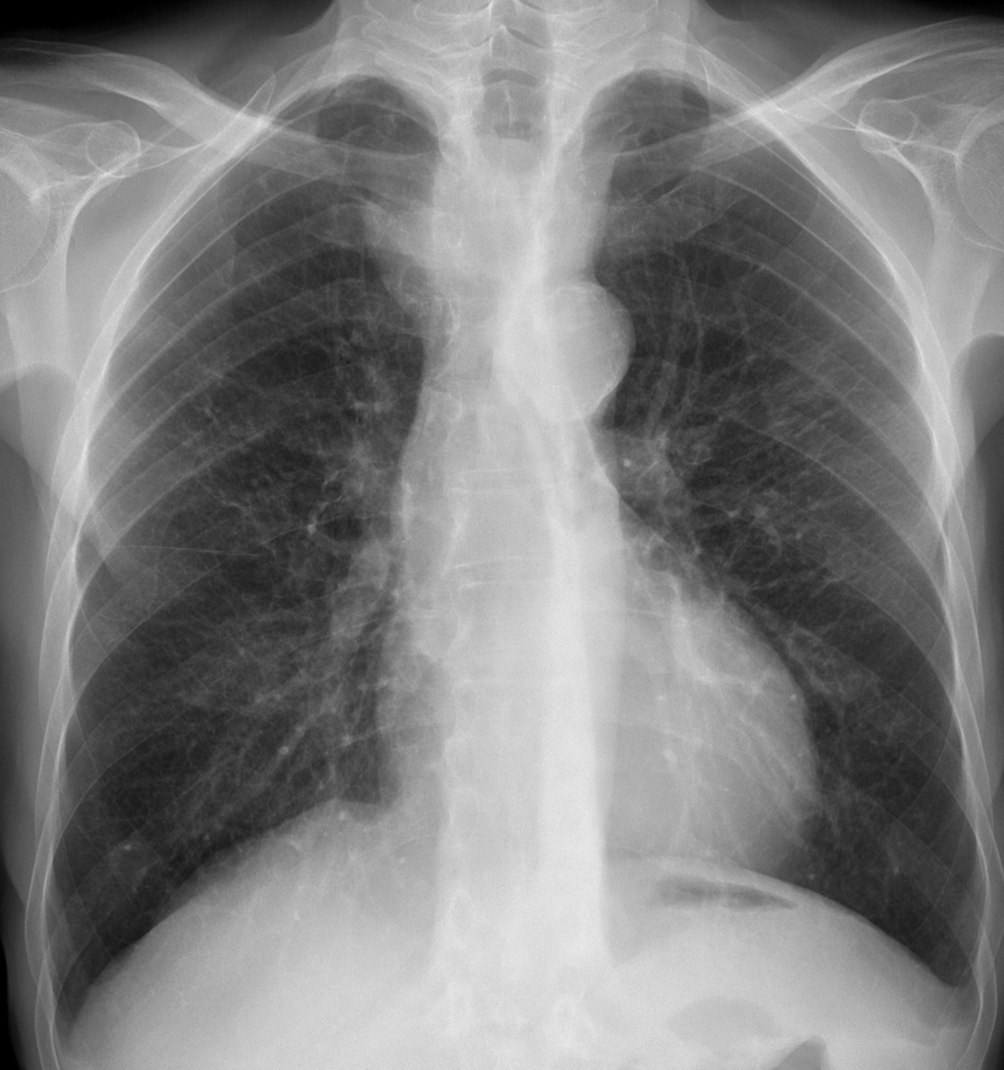 63-year-old man, PA chest