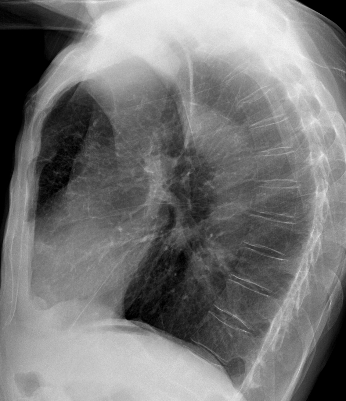63-year-old man, lateral chest