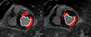 Contiguous short-axis sections of the heart from a patient with two previous myocardial infarctions. Endocardial border marked in white. Two different necrotic areas are evident (in red), one at the level of the inferolateral wall, predominantly transmural, involving about 75% of the thickness of the myocardium; and one at the level of the anterior wall, where the necrosis is predominantly non-transmural, involving 25–50% of the thickness.