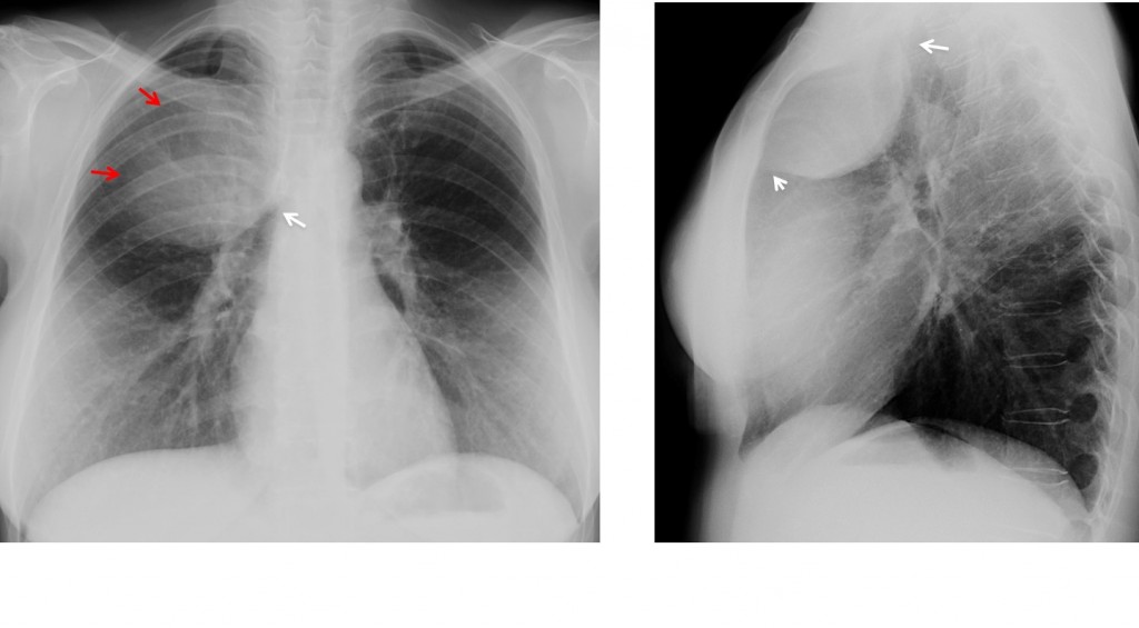 Caceres’ Corner Case 101 (Update: Solution) | Blog