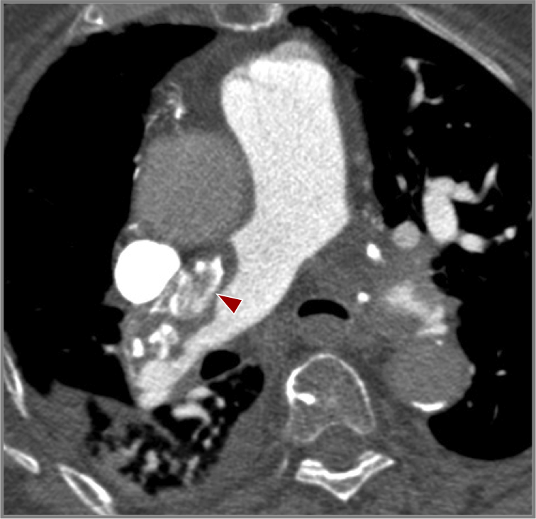 Fig 8. Gran trombo periférico en arteria pulmonar principal derecha, con calcificaciones groseras (flecha).