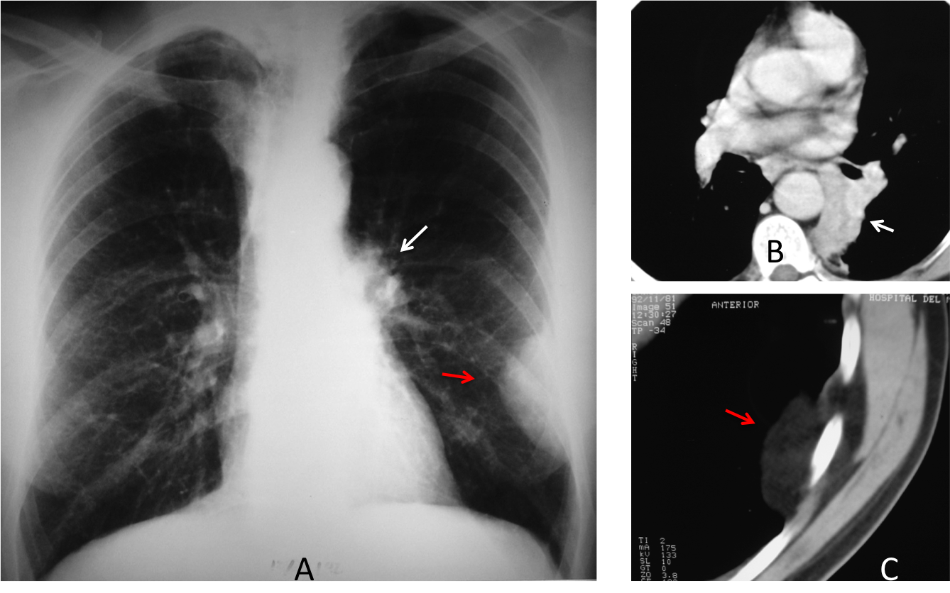 Fig. 5: Varón de 57 años con carcinoma broncogénico. La radiografía PA de tórax muestra un hilio tumoral (A, flecha) y una lesión extrapulmonar (A, flecha roja). TC confirma un colapso parcial de LII (B, flecha). La masa visible en la placa PA corresponde a grasa parietal (C, flecha roja) y por tanto, carece de significado.  
