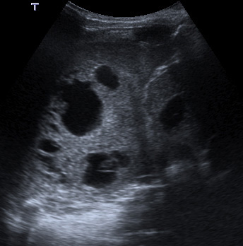 Figure 1b: Imaging of the chest no longer necessitates ionising radiation: pleuropulmonary blastoma diagnosed on ultrasound.