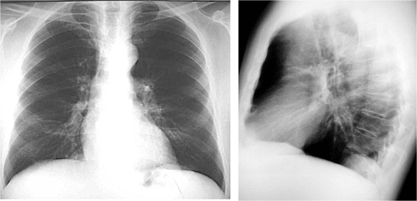 CASE 3: 65-year-old man with moderate dyspnoea