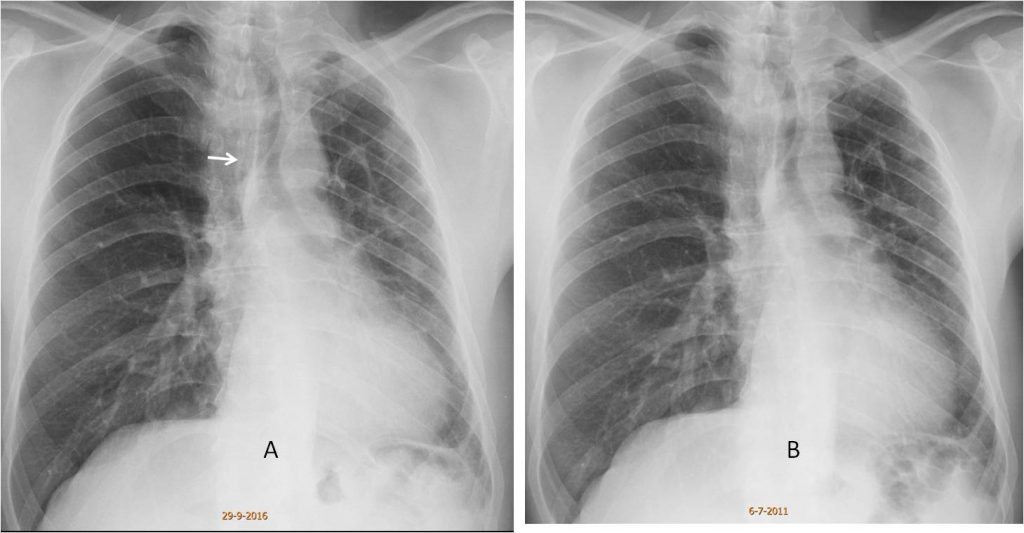 Caceres’ Corner Case 145 (Update: Solution) | Blog