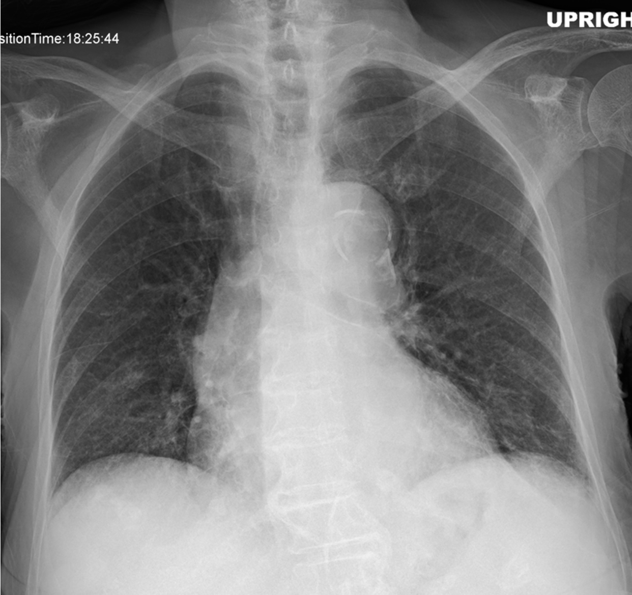 aortic dissection x ray